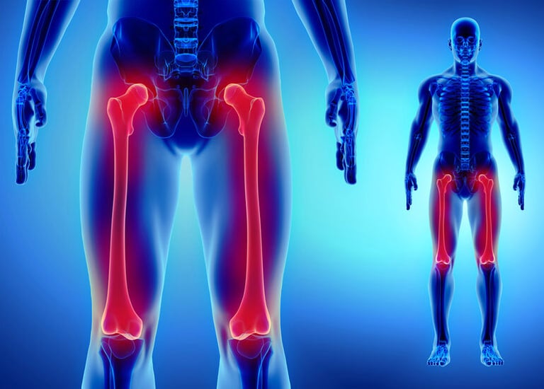 3D medical illustration showing inflammation in the hip and thigh joints of men